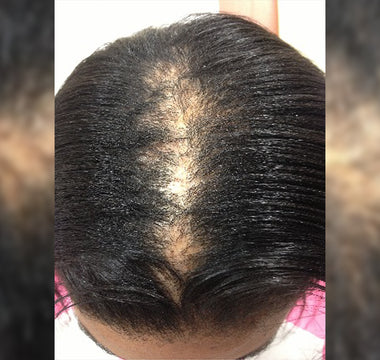 Prevent Hair Loss with Black Hair Women